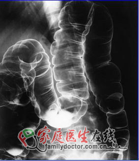 CT檢查、X線檢查等常用醫(yī)學(xué)影像學(xué)檢查方法的價值和局限
