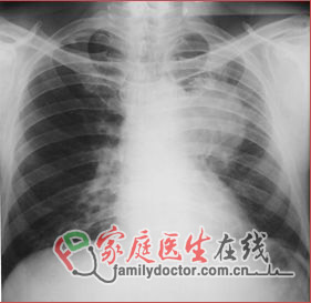 CT檢查、X線檢查等常用醫(yī)學(xué)影像學(xué)檢查方法的價值和局限