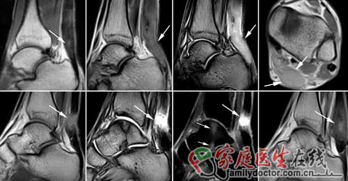 劉翔跟腱手術(shù)成功 專家：確診及治療有賴磁共振
