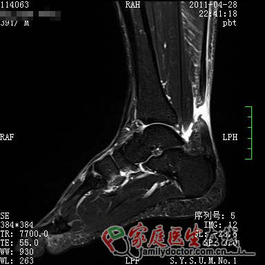 劉翔跟腱手術(shù)成功 專家：確診及治療有賴磁共振