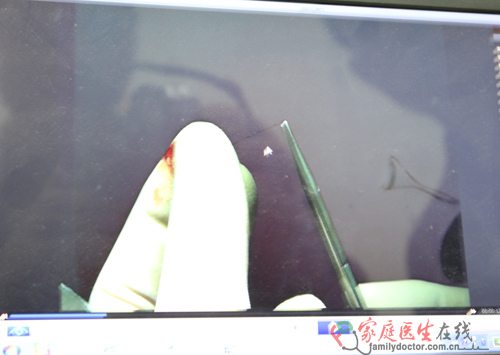 手術(shù)挖出來(lái)的線