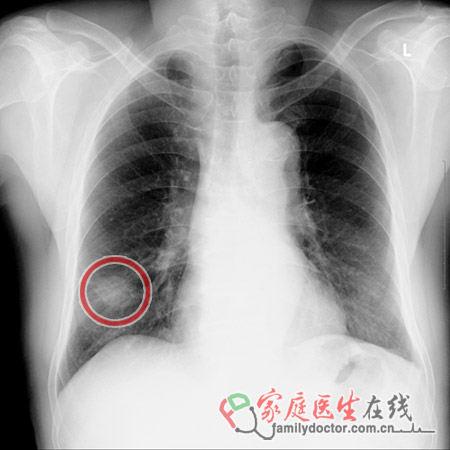 陶喆父親陶大偉肺癌病逝 肺癌篩查靠什么？